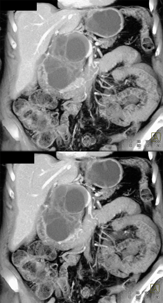 SPEN Tumors of the Pancreas