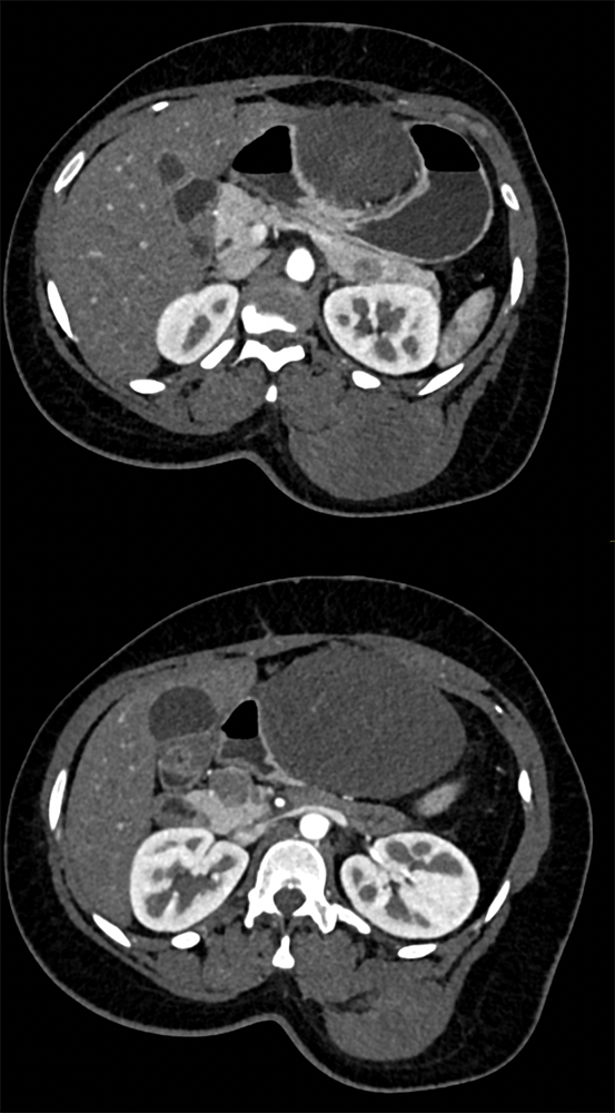 Abdominal Mass