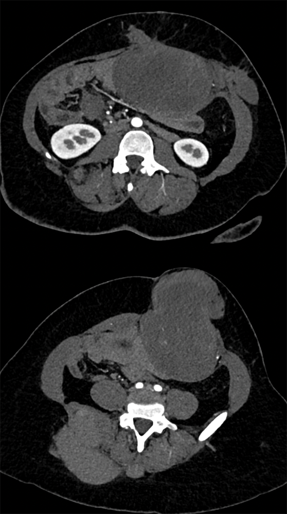 SPEN Tumors of the Pancreas