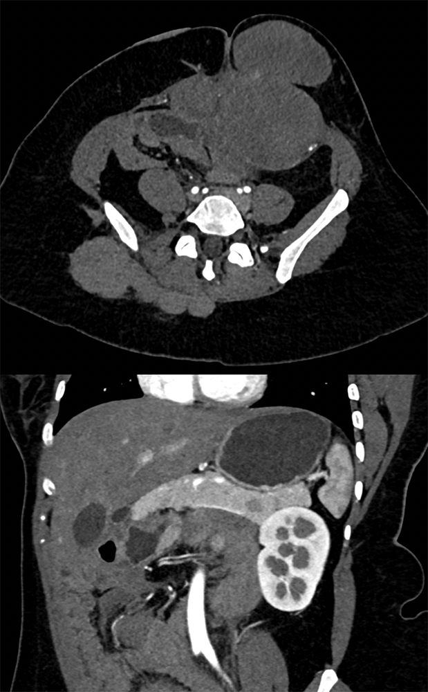 SPEN Tumors of the Pancreas