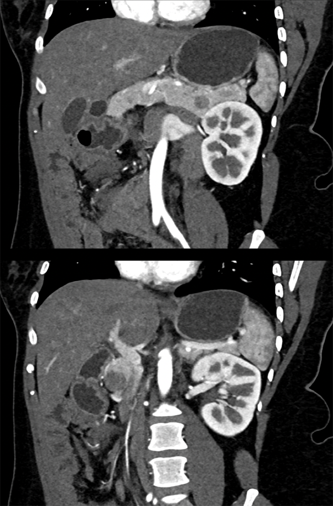 SPEN Tumors of the Pancreas