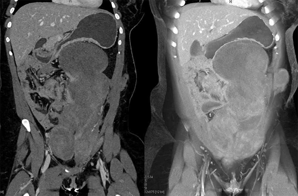 SPEN Tumors of the Pancreas