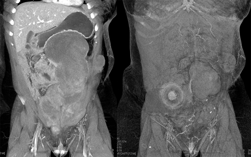 SPEN Tumors of the Pancreas