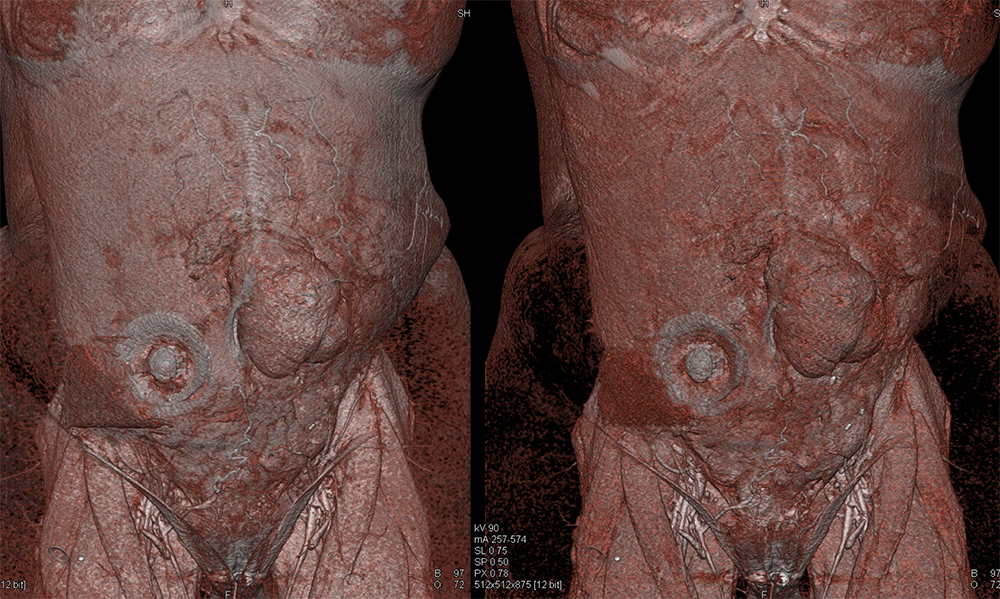 SPEN Tumors of the Pancreas