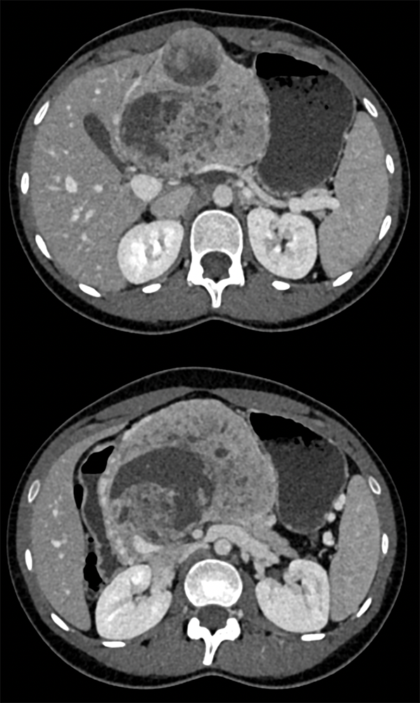 SPEN Tumors of the Pancreas