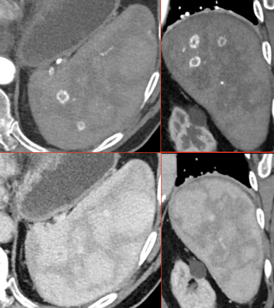 Hemangioma