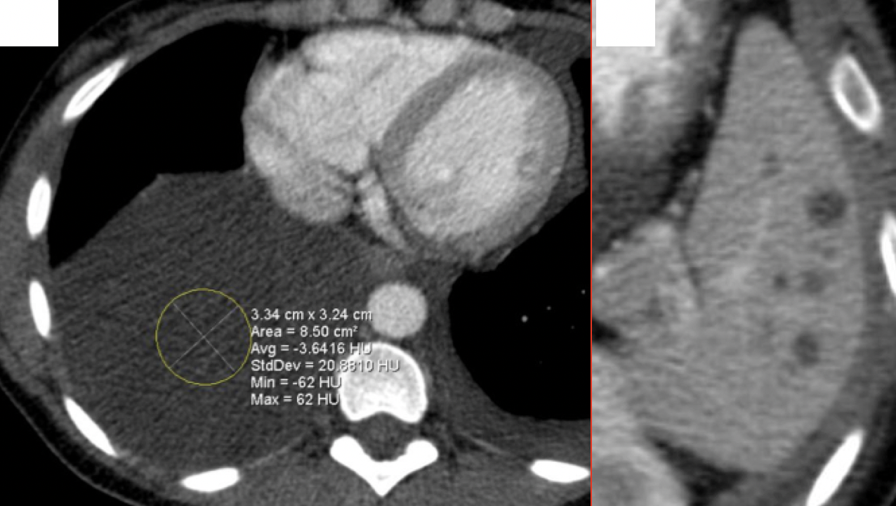 Lymphangiomatosis