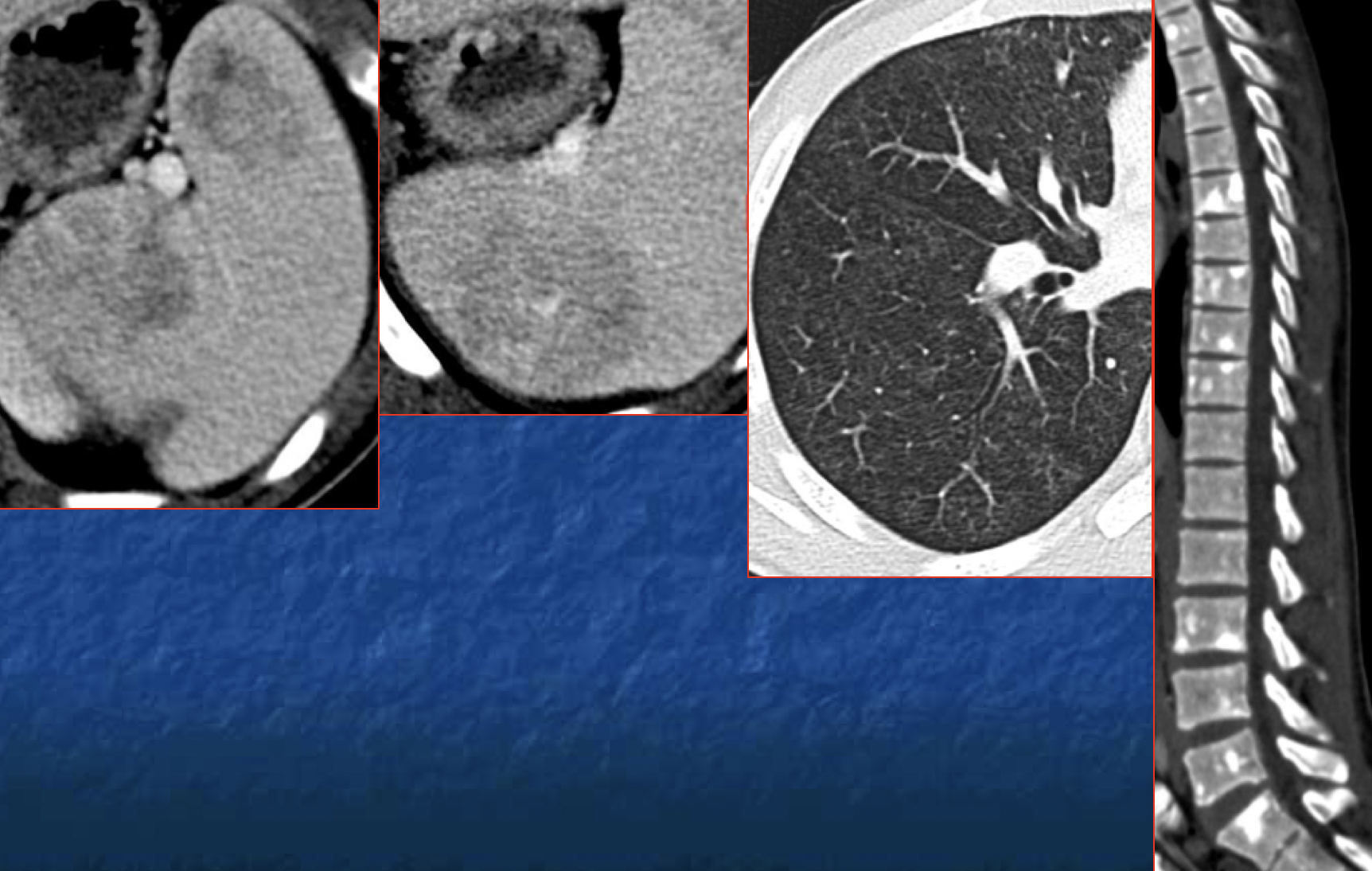 Inflammatory – Langerhans CellHistiocytosis (LCH).