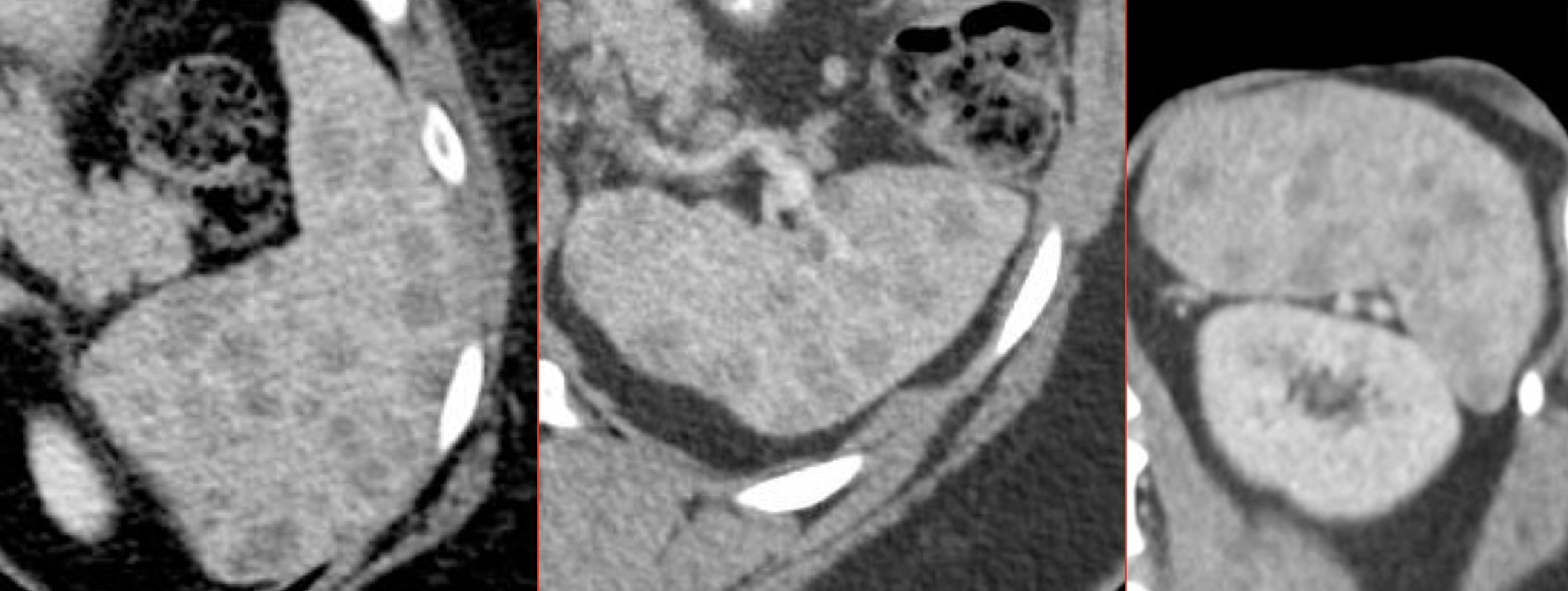 Inflammatory – Sarcoidosis