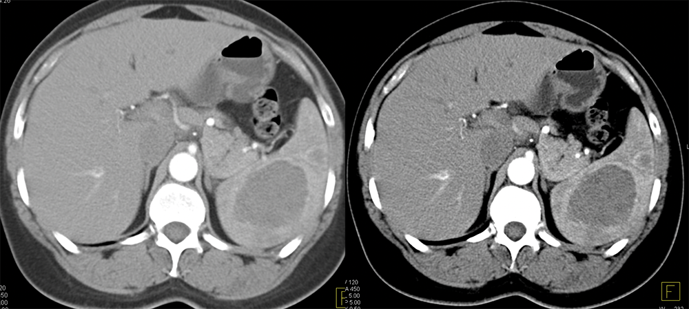 Littoral Cell Angioma