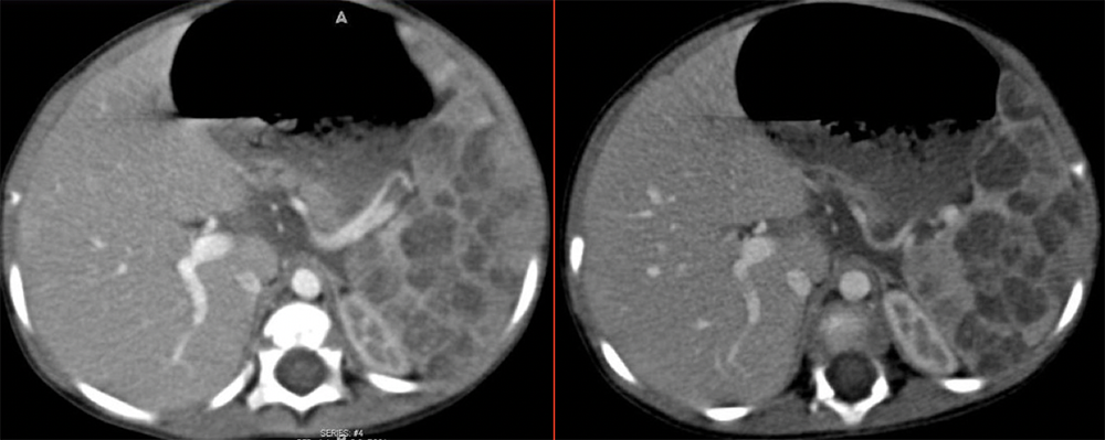 Littoral Cell Angioma in KMS