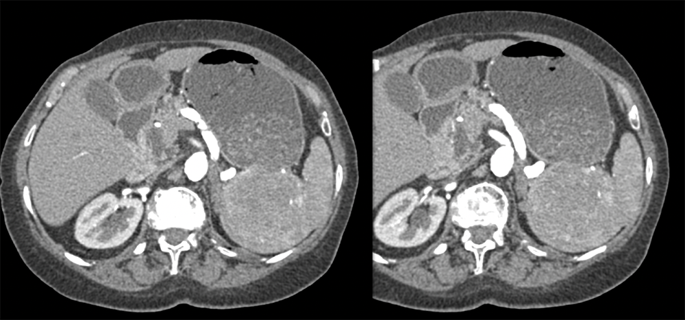 Splenic Hamartoma