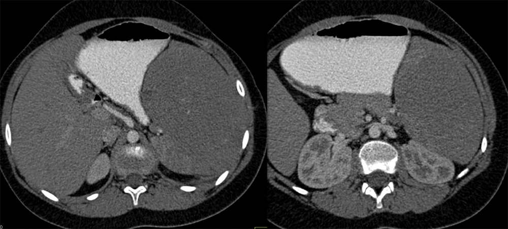 Inflammatory Pseudotumor of the Spleen