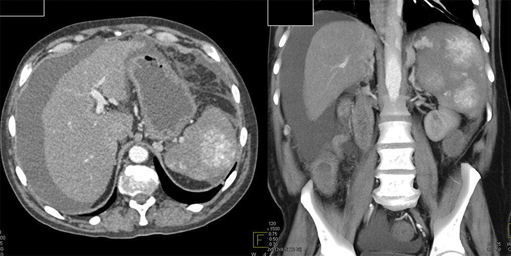 Angiosarcoma Spleen and Liver