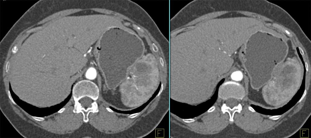 Metastatic Ovarian cancer to Spleen