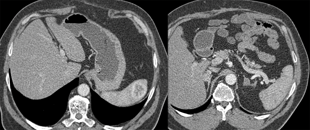 Splenic and Adrenal Metastases from RCC