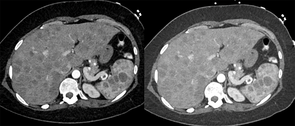 Melanoma Metastatic to the Liver and Spleen