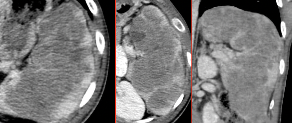 Metastasis can be cystic