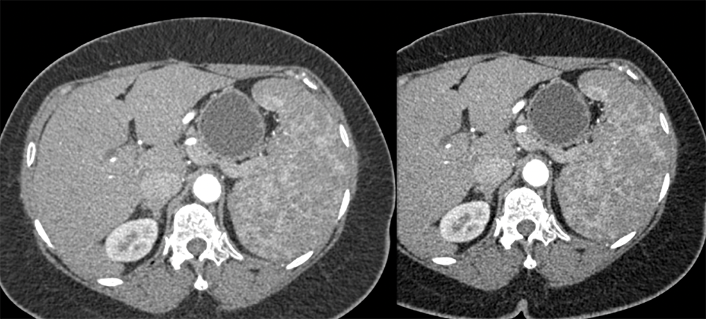 B-Cell Lymphoma Spleen