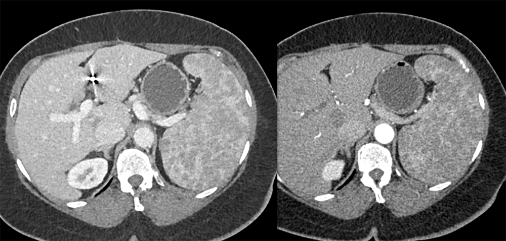 Arterial vs Venous