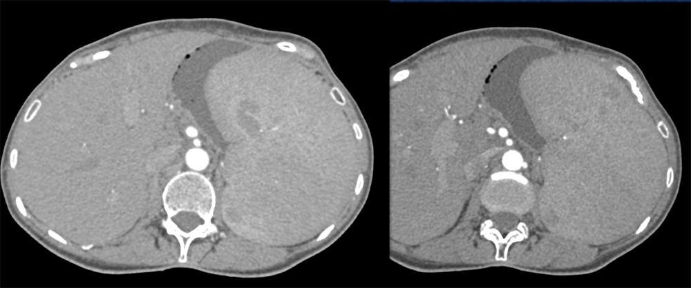 CLL Infiltrates the Spleen