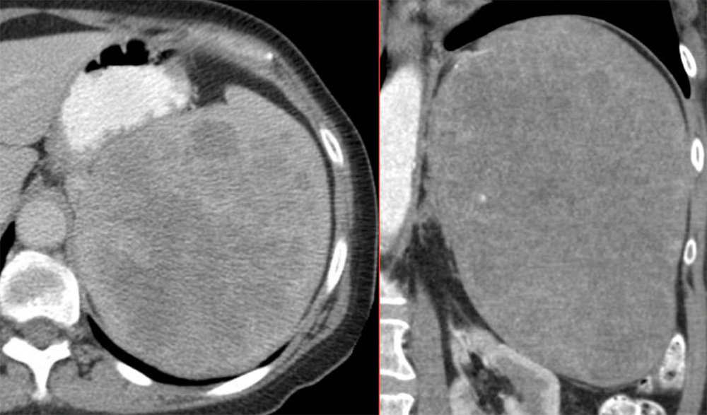 Hemangiosarcoma - Epithelioid