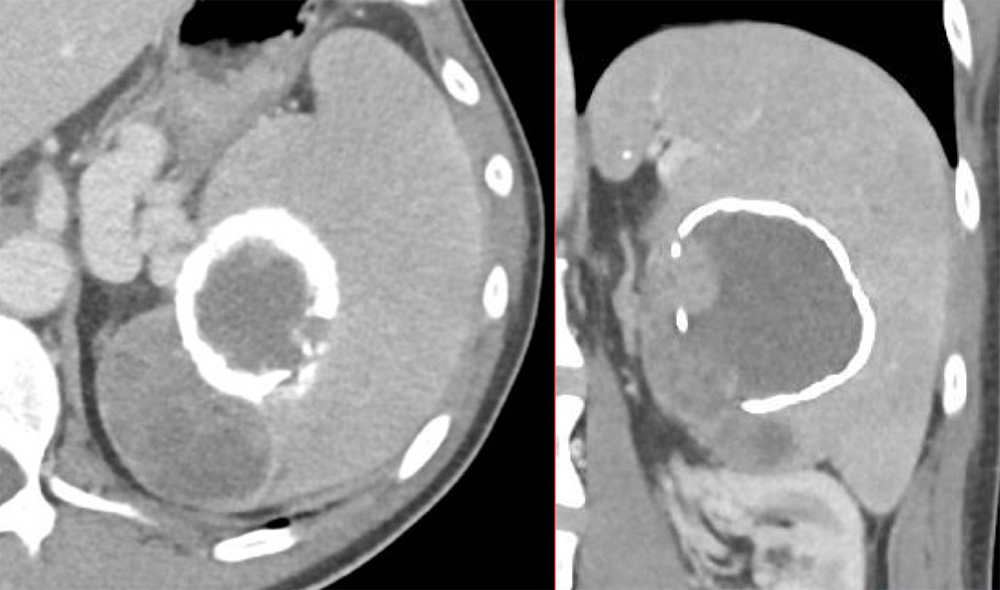 Hemangiosarcoma - Pleiomorphic