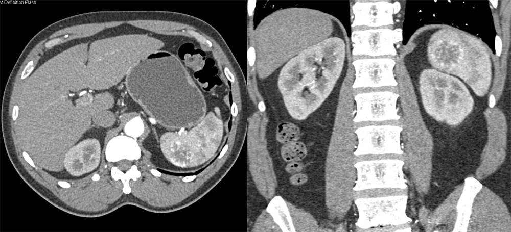 Splenic Hemangioma