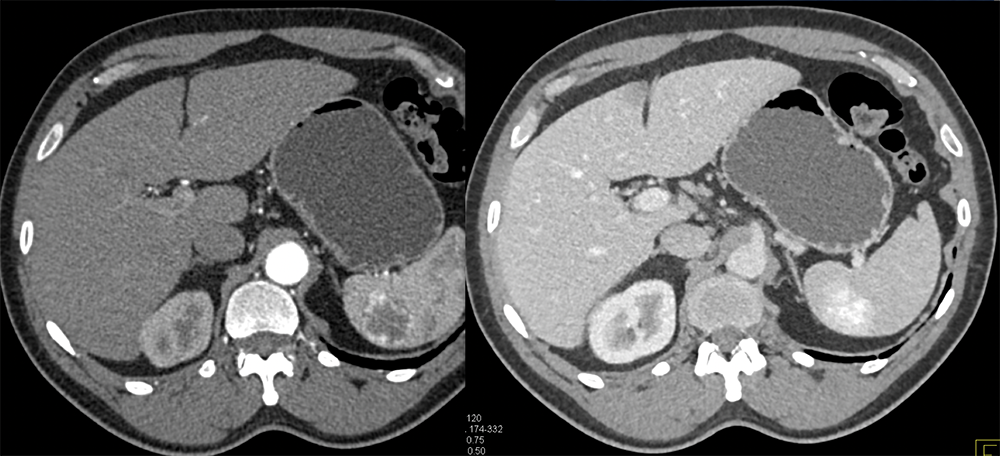 Splenic Hemangioma