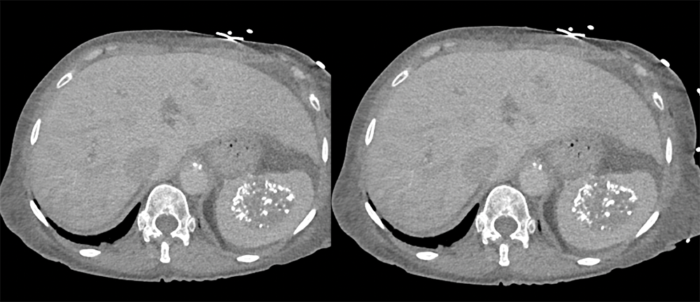 Splenic Hemangioma