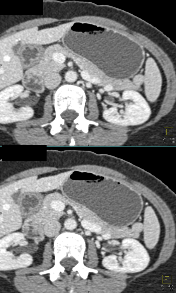 CT of Splenic Anomalies