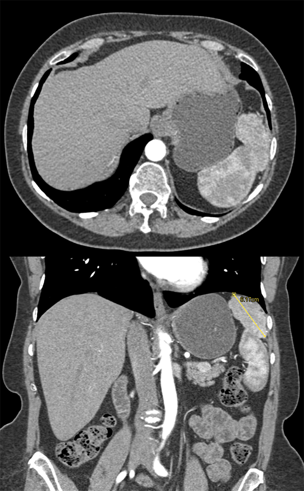 Mass Above Spleen is Accessory Spleen