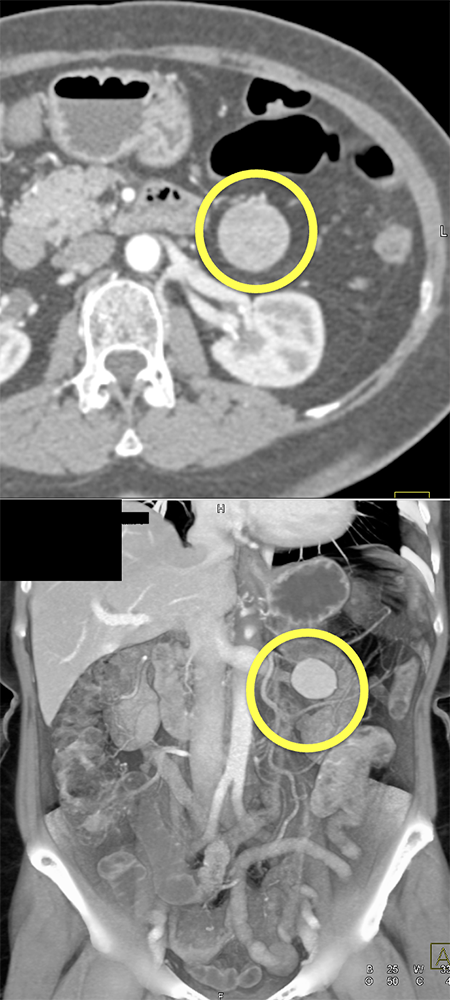 Unusual Accessory Spleen