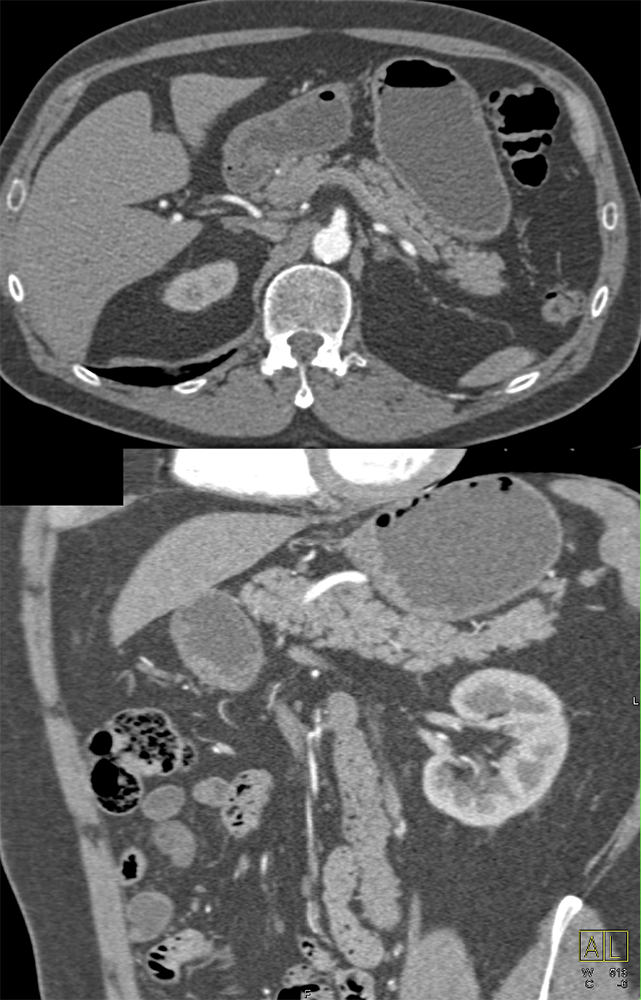 ? Insulinoma;  f/u splenule at surgery