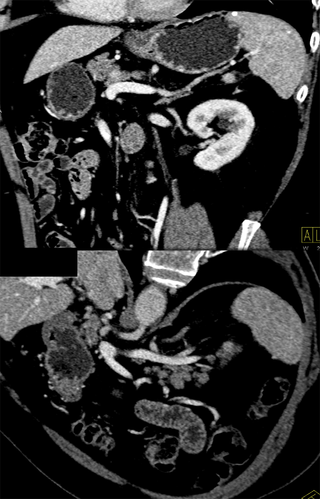 CT of Splenic Anomalies