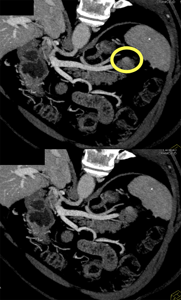 CT of Splenic Anomalies