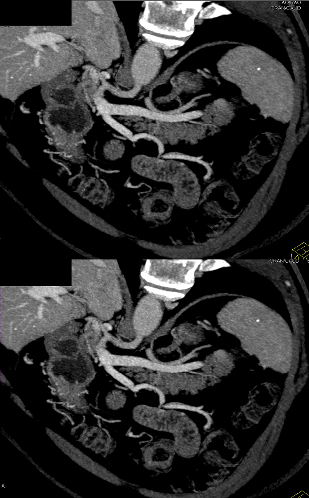 CT of Splenic Anomalies