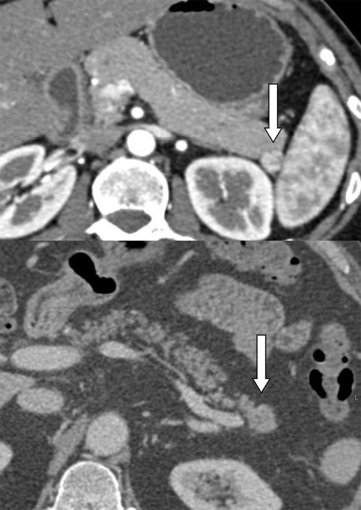 Accessory spleens mimicking pancreatic NET