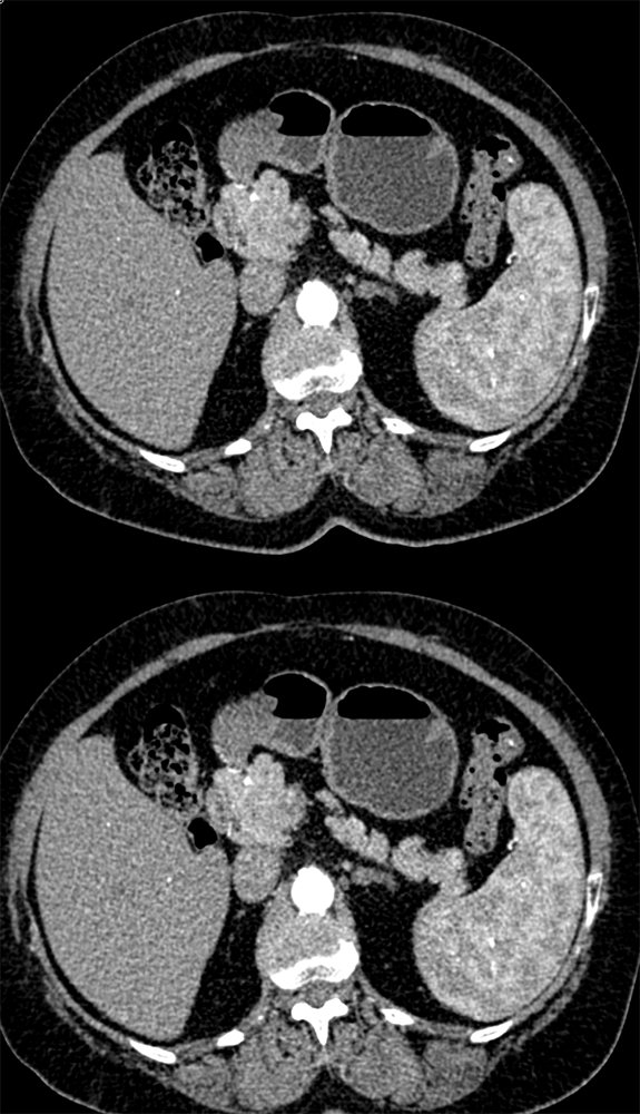 Accessory Spleen Near Tail of Pancreas