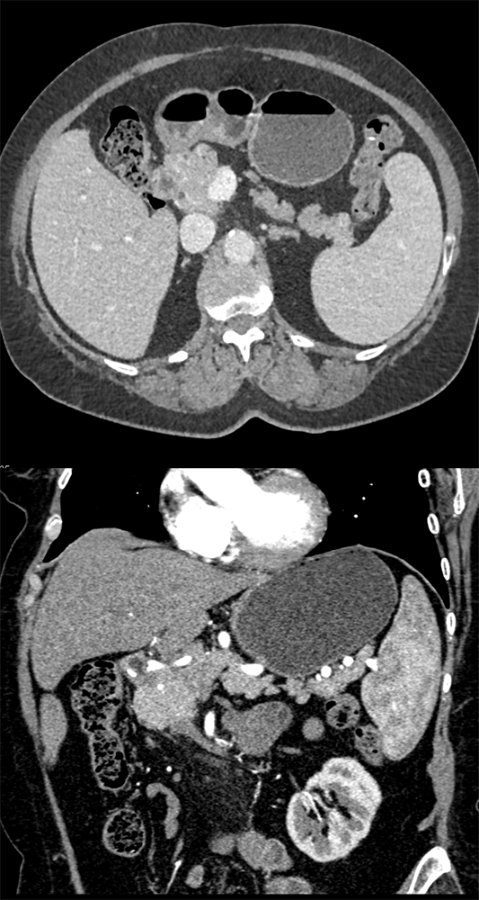 CT of Splenic Anomalies