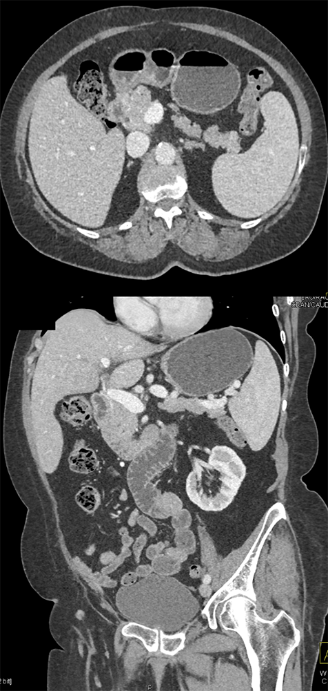 CT of Splenic Anomalies