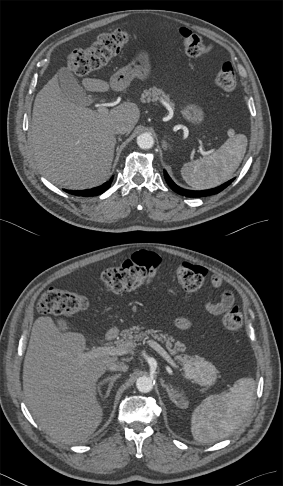 Accessory Spleen Involves TOP (5 cm)