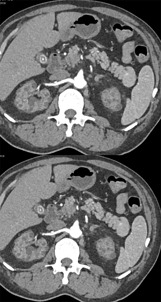 CT of Splenic Anomalies