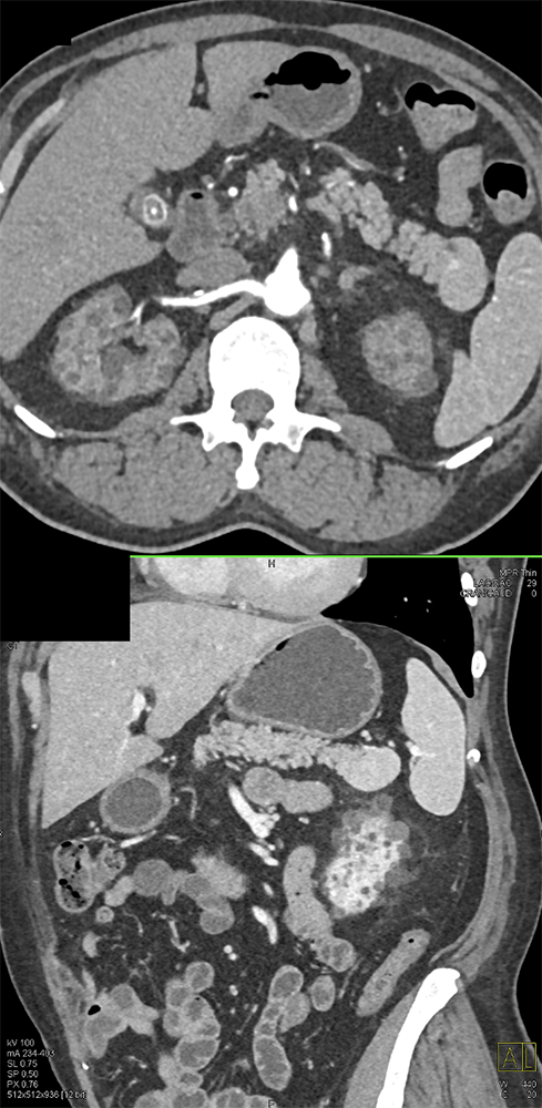 CT of Splenic Anomalies