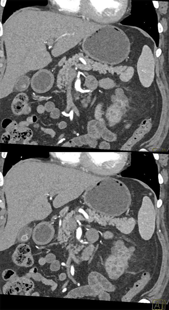 CT of Splenic Anomalies