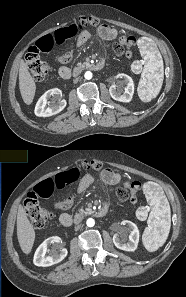 Accessory Spleen with Arterial Phase Imaging