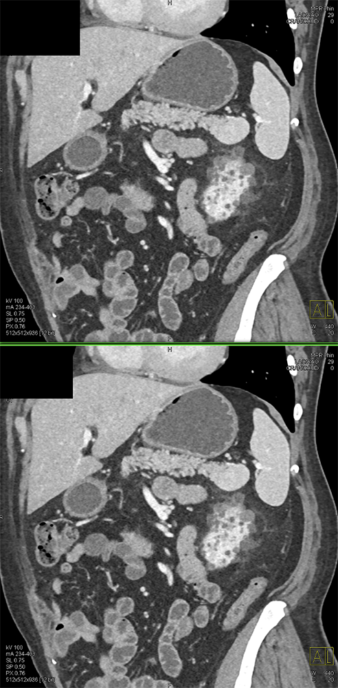 CT of Splenic Anomalies