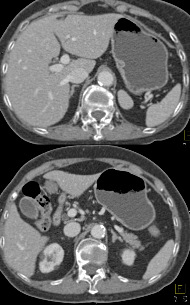 Accessory Spleen Simulates and Adrenal mass