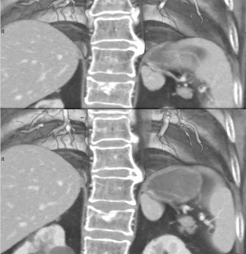 CT of Splenic Anomalies