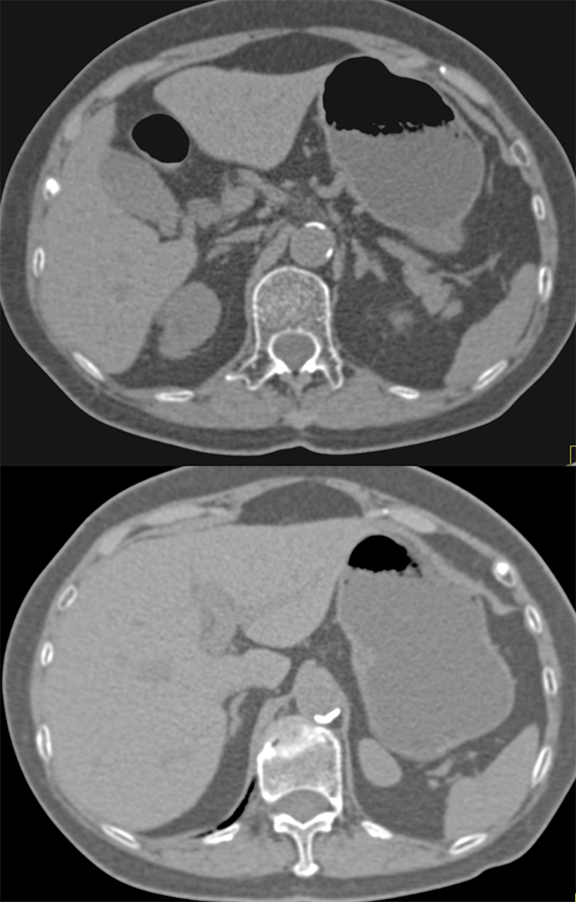 CT of Splenic Anomalies